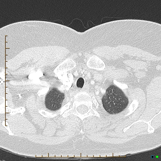 Bronchial diverticula (Radiopaedia 79512-92676 Axial lung window 7).jpg