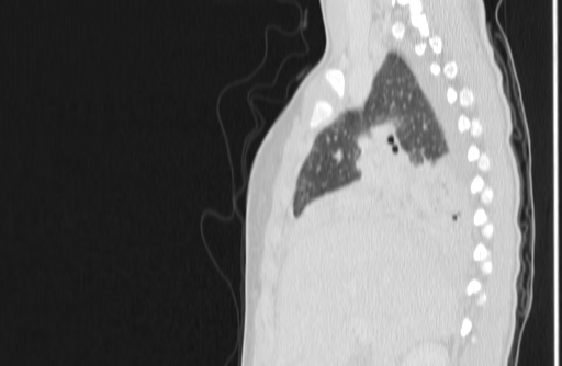 Bronchial mucoepidermoid carcinoma (Radiopaedia 57023-63895 Sagittal lung window 43).jpg