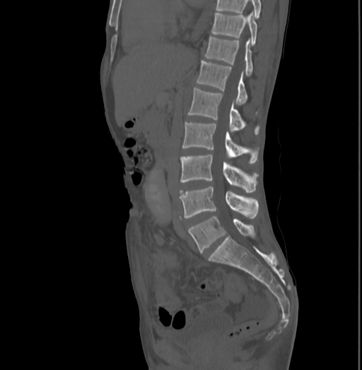 Bronchiectasis in Crohn disease (Radiopaedia 60311-67977 Sagittal bone window 119).jpg