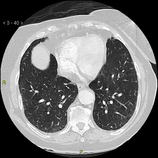 Bronchogenic carcinoma as an incidental finding (Radiopaedia 16453-16130 Axial lung window 40).jpg