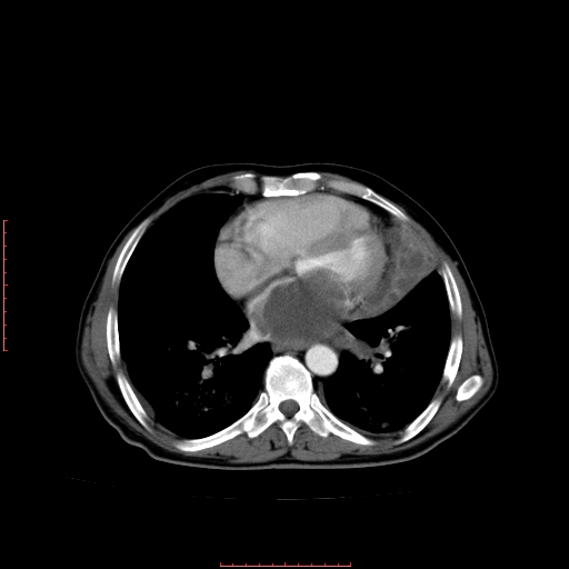File:Bronchogenic carcinoma with left atrial large deposit - T4N3M1a (Radiopaedia 42316-45428 A 19).jpg