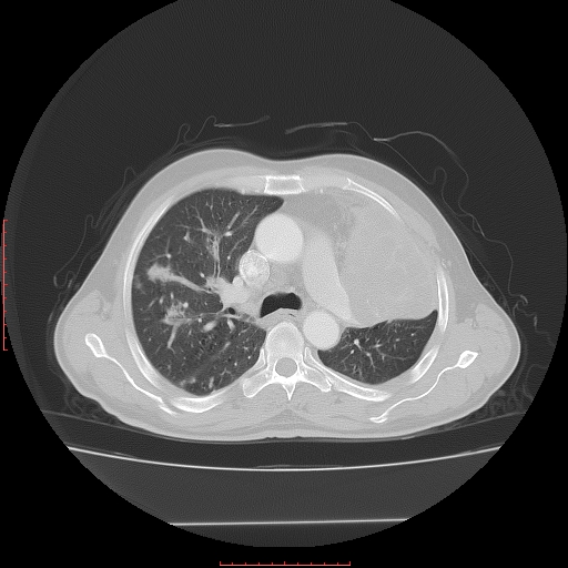 File:Bronchogenic carcinoma with left atrial large deposit - T4N3M1a (Radiopaedia 42316-45428 Axial lung window 12).jpg