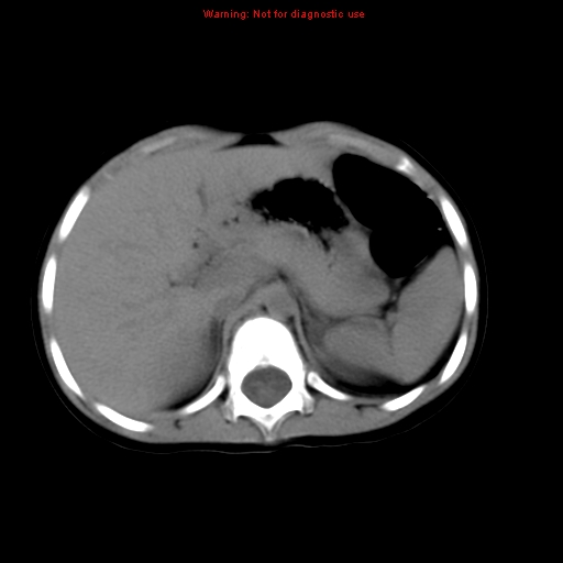 File:Bronchogenic cyst (Radiopaedia 9372-10063 Axial non-contrast 18).jpg