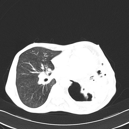 Bronchopleural fistula secondary to tuberculosis (Radiopaedia 20415-20322 Axial lung window 34).jpg