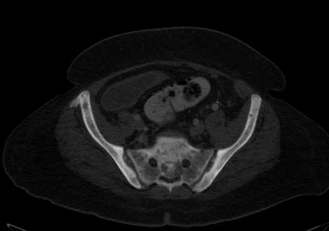 Brown tumors compressing the spinal cord (Radiopaedia 68442-77988 G 98).jpg