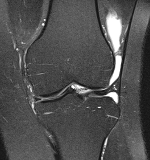 File:Bucket handle tear - medial meniscus (Radiopaedia 79028-91942 Coronal PD fat sat 12).jpg