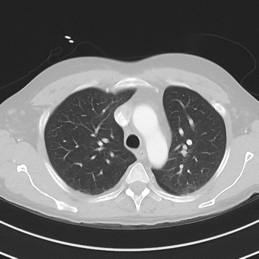 Burkitt lymphoma (Radiopaedia 34686-36121 Axial lung window 16).png