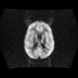 File:Burkitt lymphoma of the orbit- pre and post chemotherapy (Radiopaedia 31214-31930 Axial DWI 11).jpg