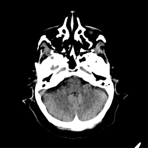 File:CNS Lymphoma (Radiopaedia 44198-47794 Axial non-contrast 9).png