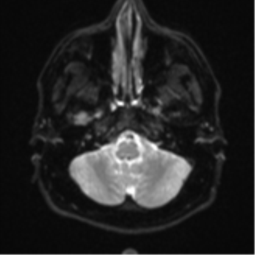 File:CNS vasculitis (Radiopaedia 55715-62263 Axial DWI 5).png