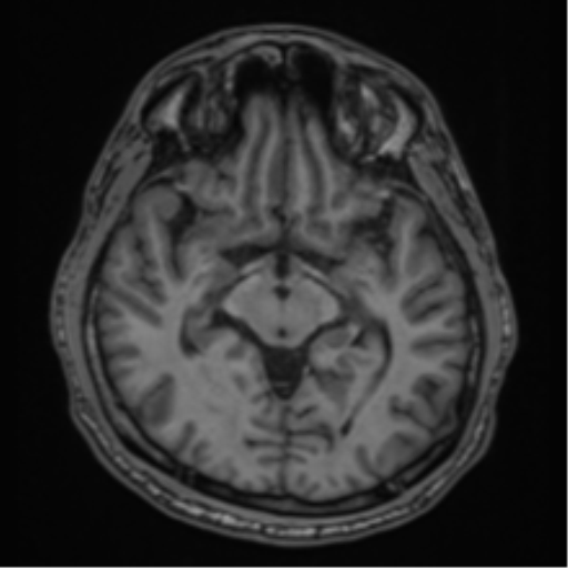 CNS vasculitis (Radiopaedia 55715-62263 Axial T1 17).png