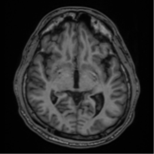 CNS vasculitis (Radiopaedia 55715-62263 Axial T1 22).png