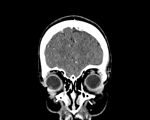 File:Calcified cerebral hydatid cyst (Radiopaedia 65603-74717 C 8).jpg