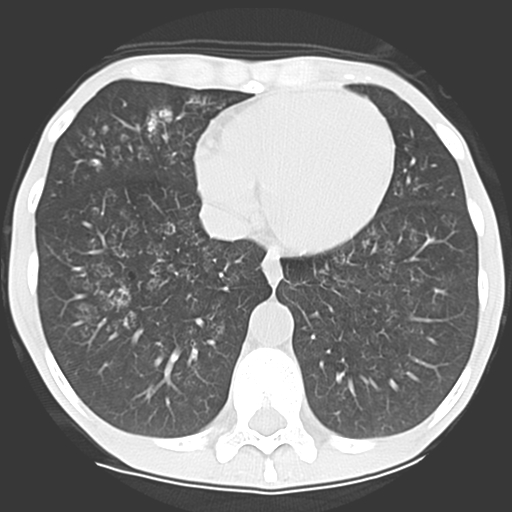 File:Calciphylaxis and metastatic pulmonary calcification (Radiopaedia 10887-11317 Axial lung window 35).jpg