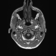 Callosal dysgenesis with interhemispheric cyst (Radiopaedia 53355-59335 Axial T1 4).jpg