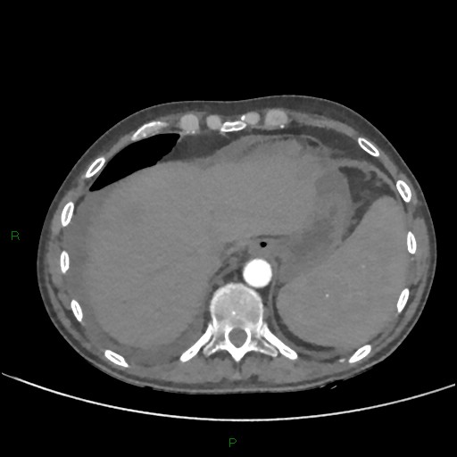 Cannonball metastases (Radiopaedia 82110-96150 Axial C+ CTPA 271).jpg