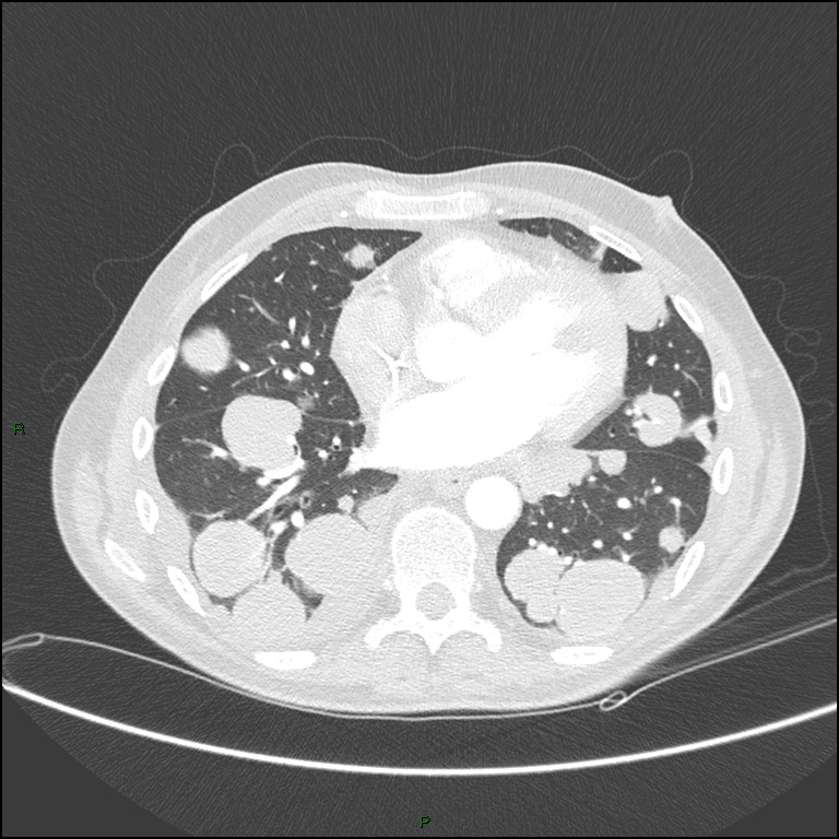 Cannonball metastases (Radiopaedia 82110-96150 Axial lung window 125).jpg