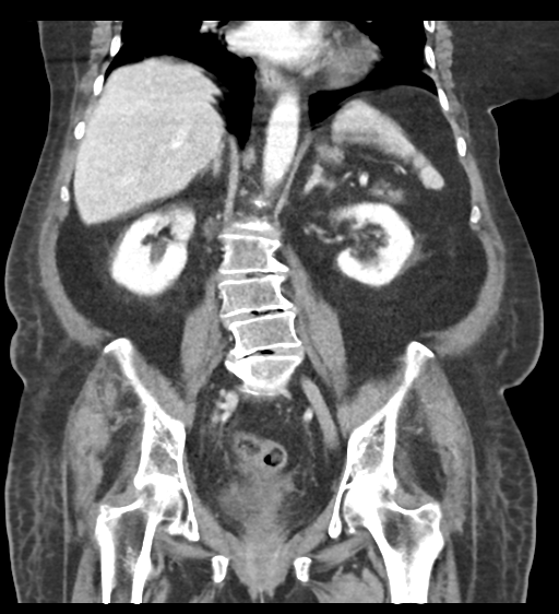 Cannonball metastases from endometrial cancer (Radiopaedia 42003-45031 F 42).png