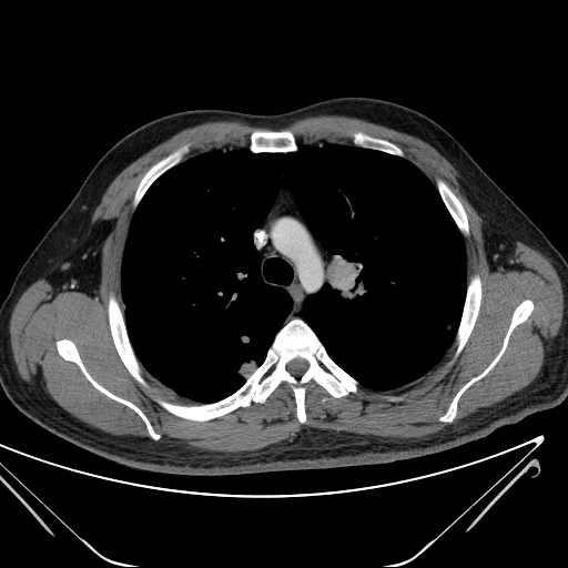 File:Cannonball pulmonary metastases (Radiopaedia 67684-77101 D 94).jpg
