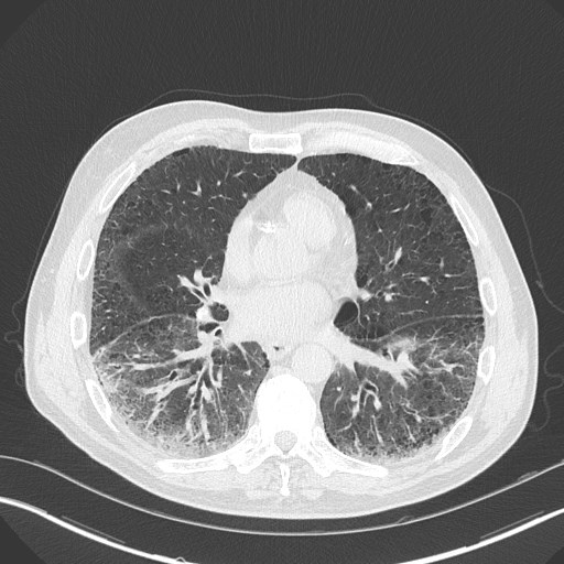 Caplan syndrome (Radiopaedia 56667-63530 Axial lung window 119).jpg