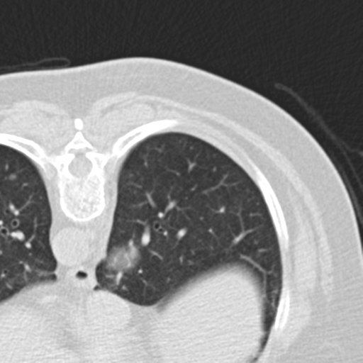 File:Carcinoid tumor - lung (Radiopaedia 44814-48644 Axial lung window 53).png