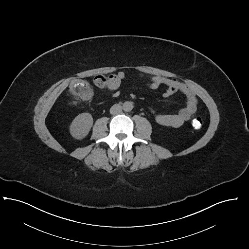 Carcinoid tumor - terminal ileum (Radiopaedia 60931-68740 Axial non-contrast 61).jpg