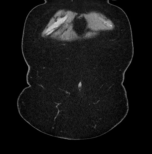 Carcinoid tumor - terminal ileum (Radiopaedia 60931-68740 Coronal non-contrast 1).jpg