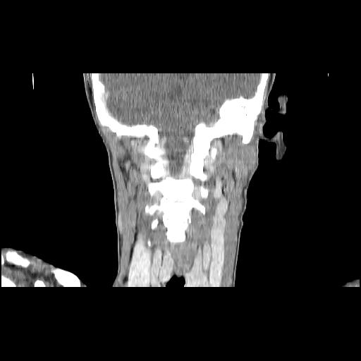 File:Carcinoma of the maxillary antrum (Radiopaedia 53805-59888 Coronal C+ delayed 113).jpg