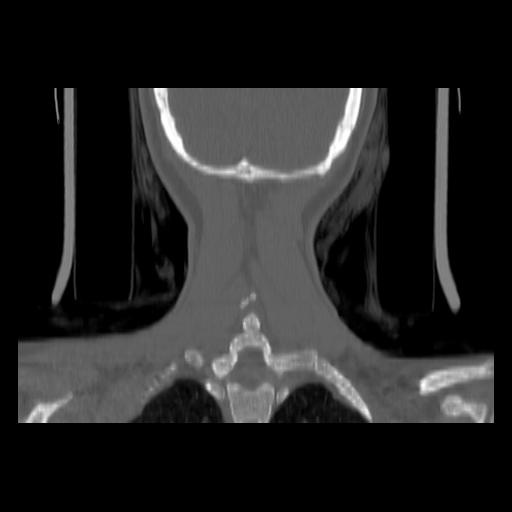 Carcinoma of the maxillary antrum (Radiopaedia 53805-59888 Coronal bone window 135).jpg