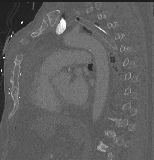 Cardiac trauma (Radiopaedia 32874-33858 Sagittal bone window 21).jpg