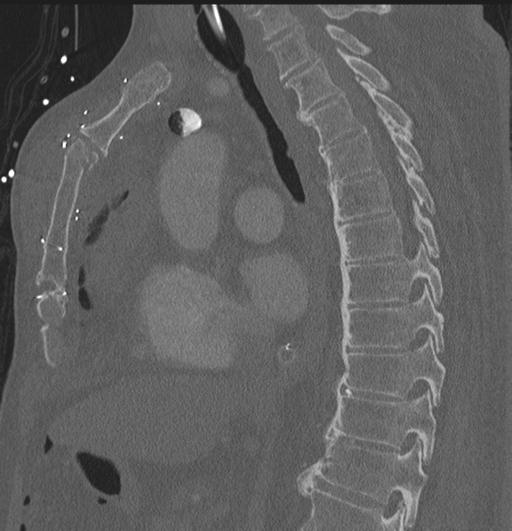 Cardiac trauma (Radiopaedia 32874-33858 Sagittal bone window 47).jpg