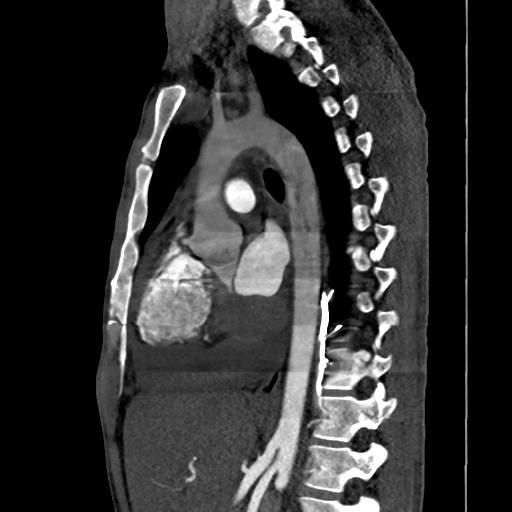 Cardiac tumor - undifferentiated pleomorphic sarcoma (Radiopaedia 45844-50134 B 35).png