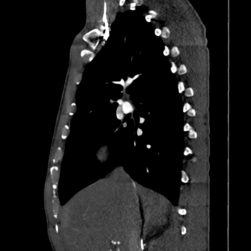 Cardiac tumor - undifferentiated pleomorphic sarcoma (Radiopaedia 45844-50134 B 52).png