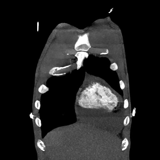 File:Cardiac tumor - undifferentiated pleomorphic sarcoma (Radiopaedia 45844-50134 Coronal non-contrast 8).png