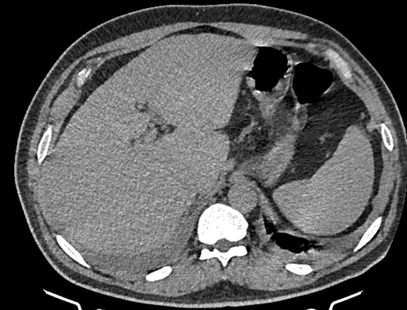 Cardiogenic pulmonary edema (Radiopaedia 68180-77678 Axial non-contrast 57).jpg