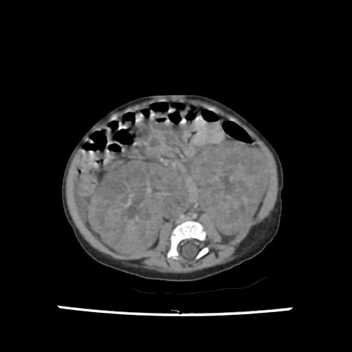 Caroli disease with autosomal recessive polycystic kidney disease (ARPKD) (Radiopaedia 89651-106703 B 140).jpg