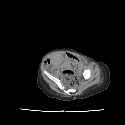 File:Caroli disease with autosomal recessive polycystic kidney disease (ARPKD) (Radiopaedia 89651-106703 B 195).jpg