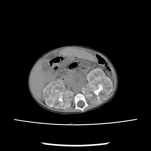 Caroli disease with autosomal recessive polycystic kidney disease (ARPKD) (Radiopaedia 89651-106703 E 108).jpg
