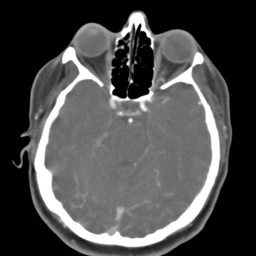 File:Carotico ophthalmic aneurysm (Radiopaedia 42916-46148 A 36).png