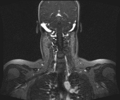 Carotid body tumor (Radiopaedia 12777-12912 MRA 48).jpg