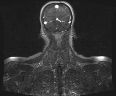 Carotid body tumor (Radiopaedia 12777-12912 MRA 69).jpg