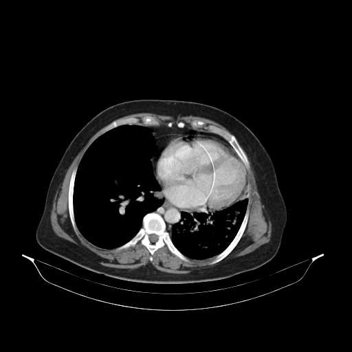 File:Carotid body tumor (Radiopaedia 21021-20948 B 47).jpg