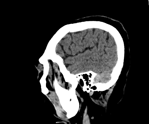 Cavernous hemangioma of the cerebellar falx (Radiopaedia 73025-83723 B 58).jpg