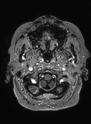 Cavernous hemangioma of the cerebellar falx (Radiopaedia 73025-83724 Axial T1 C+ 315).jpg