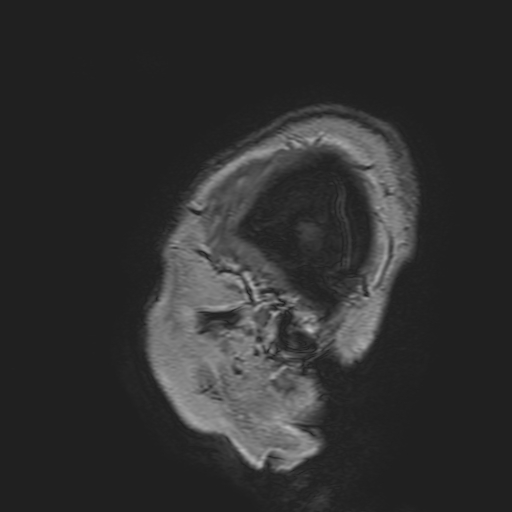 File:Cavernous hemangioma of the cerebellar falx (Radiopaedia 73025-83724 Sagittal T1 11).jpg