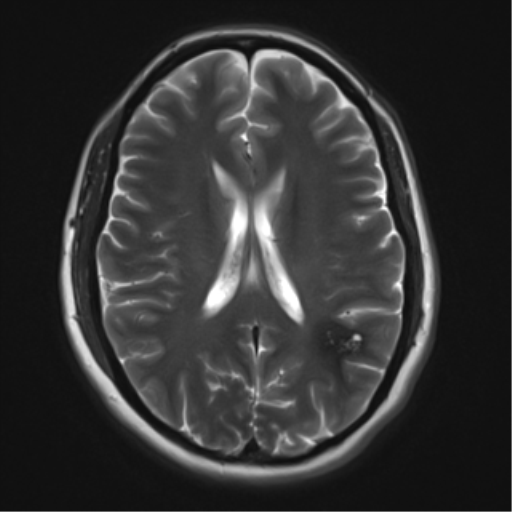 File:Cavernous malformation (cavernous angioma or cavernoma) (Radiopaedia 36675-38237 Axial T2 13).png