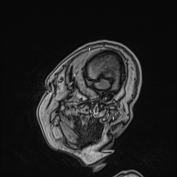 Cavernous sinus meningioma (Radiopaedia 63682-72367 Sagittal T1 C+ 27).jpg