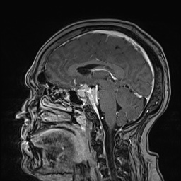 Cavernous sinus meningioma (Radiopaedia 63682-72367 Sagittal T1 C+ 96).jpg