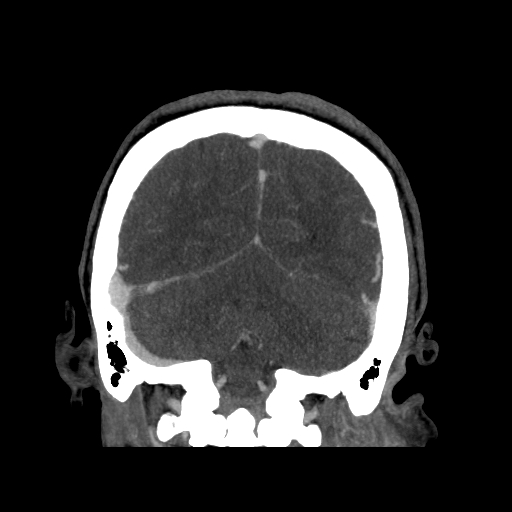 File:Cavernous sinus thrombosis (Radiopaedia 10619-11078 D 25).jpg