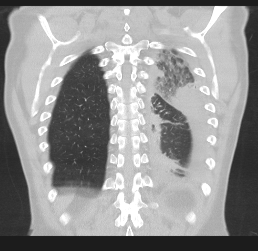 Cavitating pneumonia complicated by pneumothorax (Radiopaedia 48149-52994 Coronal lung window 47).png